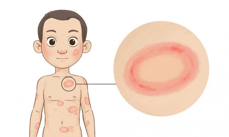 Dermatophyte Infections (Ringworm) | eMedicineHub