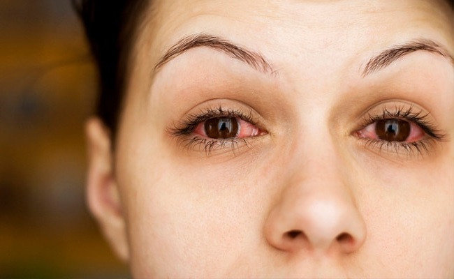 Conjunctivitis: The Causes and Best Homeopathic Eye Drops
