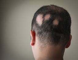 Homeopathy Medicine for Alopecia & Bald Patches