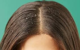 Homeopathy Medicine for Dandruff