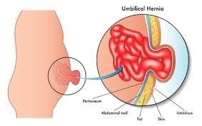 Homeopathy Medicine for Hernia