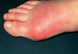 Homeopathy Medicine for Gout