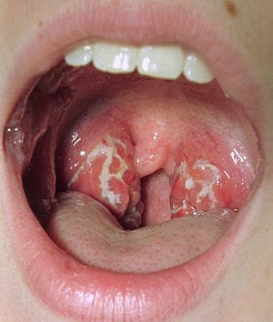 Homeopathy Medicine for Tonsillitis