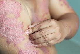 Homeopathy Medicine for Psoriasis