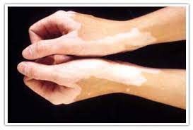 Homeopathy Medicine for Vitiligo & Leucoderma