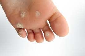Homeopathy Medicine for Corns