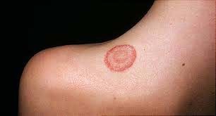 Homeopathy Medicine for Ringworm