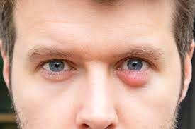 Homeopathy Medicine for Styes and Chalazion