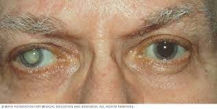 Homeopathy Medicine for Cataract