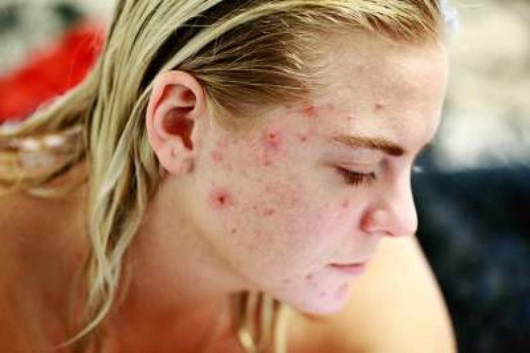 Homeopathy Medicine for Acne & Pimples